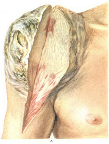 фибросаркома мягких тканей плеча